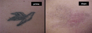 Rimozione tatuaggi - Asportazione con laser q-switched