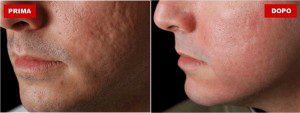 dermatologo acne a milano