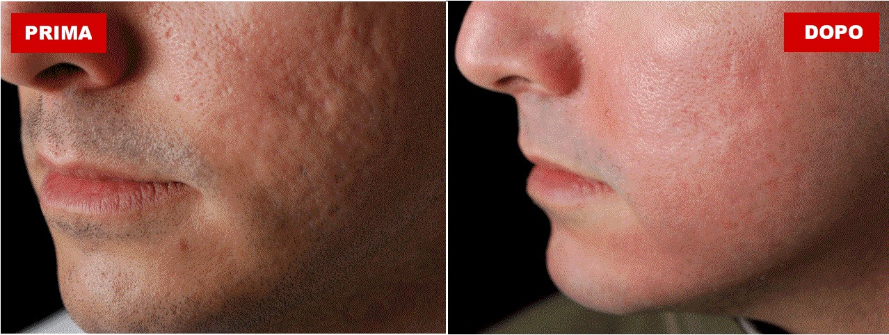 trattamento laser cicatrici acne