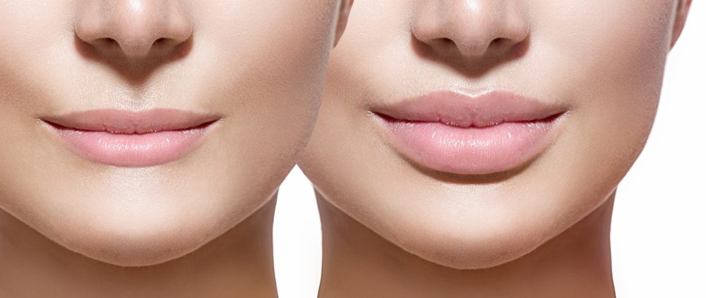 filler-labbra-botulino