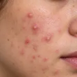 Papule e pustole dell'acne infiammatoria sulla pelle