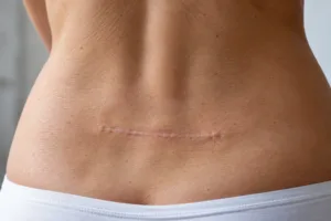 Cicatrice chirurgica Cicatrice chirurgica sulla schiena: le cicatrici possono essere attenuate in poche sedute