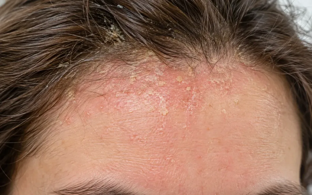 Dermatite seborroica