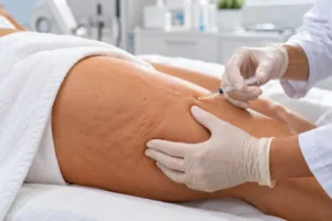 Medico che esegue un trattamento di mesoterapia anticellulite sulla coscia in ambulatorio