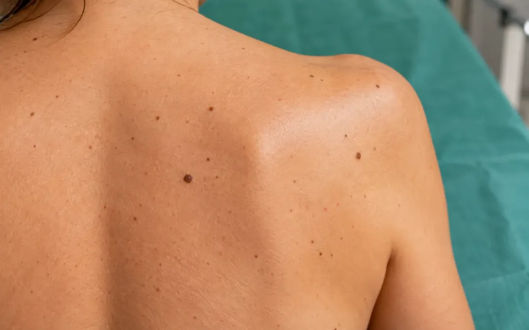 Nei sotto il sole: i rischi