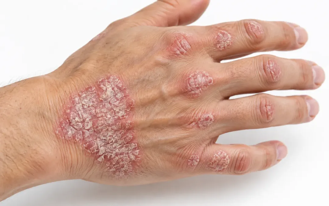 Psoriasi: le varietà della patologia, le cause e le terapie