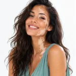 Donna sorridente con macchie di vitiligine sul viso e sul collo