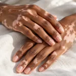 Mani con chiazze bianche di vitiligine: perdita di melanina e depigmentazione della pelle